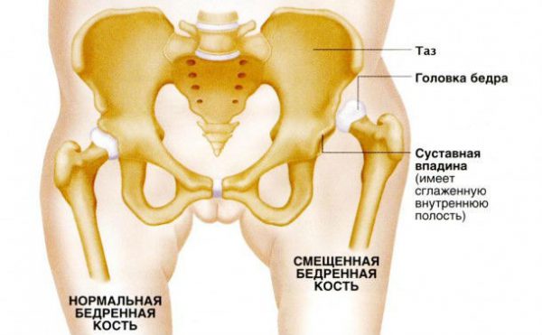 О чём говорят боли в тазобедренном суставе О чём говорят боли в тазобедренном суставе