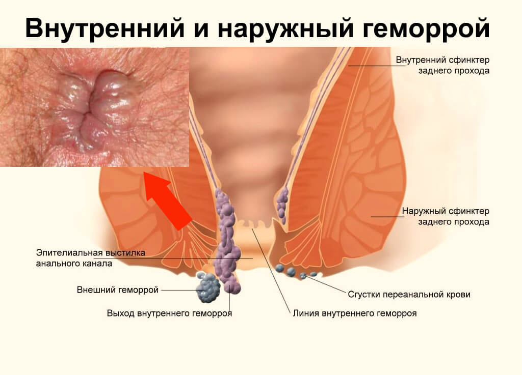 Варикозное Расширение Вен Заднего Прохода Фото