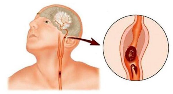 Аневризма сосудов головного мозга — симптомы и лечение