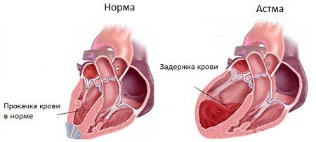 Сердечная астма — симптомы и лечение