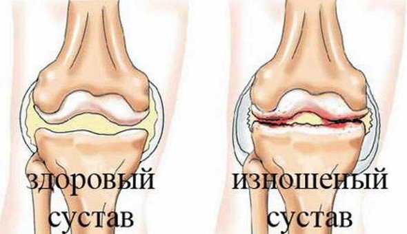Остеохондроз коленного сустава — симптомы и лечение