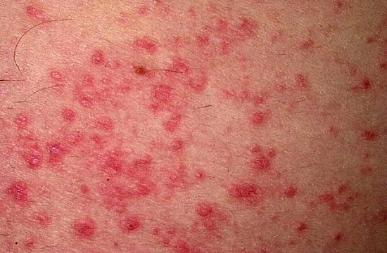 Аллергический дерматит — симптомы и лечение