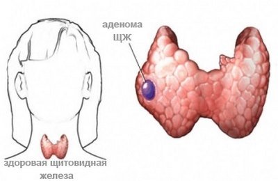 Аденома щитовидной железы — симптомы и лечение