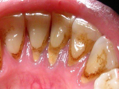 Зубной камень — симптомы и лечение
