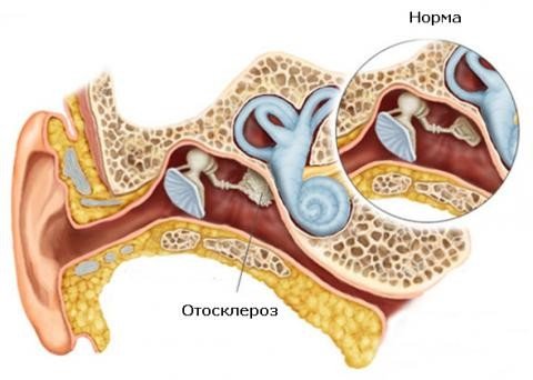 Отосклероз отоспонгиоз — симптомы и лечение