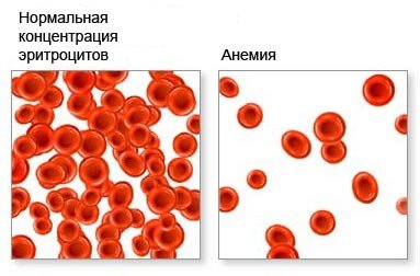 Черные точки при анемии