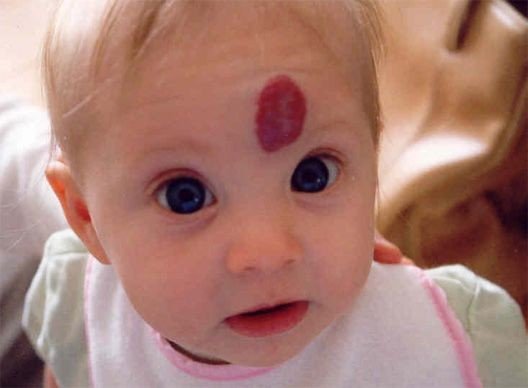 Гемангиома у детей — симптомы и лечение, фото и видео
