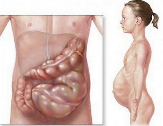 Стеноз кишечника — симптомы и лечение