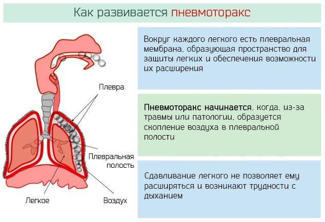 Спонтанный пневмоторакс — симптомы и лечение