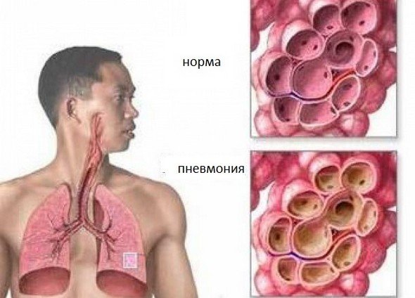 Бактериальная пневмония — симптомы и лечение