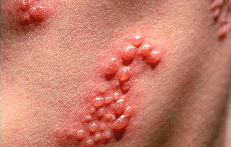 Герпетическая инфекция — симптомы и лечение