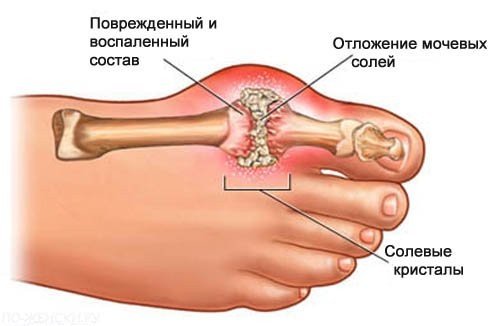 Подагрический артрит — симптомы и лечение