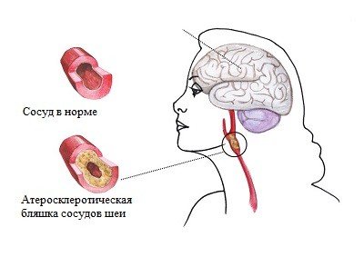 Дисциркуляторная энцефалопатия — симптомы и лечение