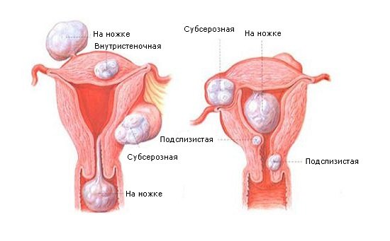 Фиброма матки — симптомы и лечение