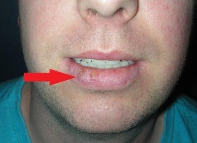 Рак губы — симптомы и лечение