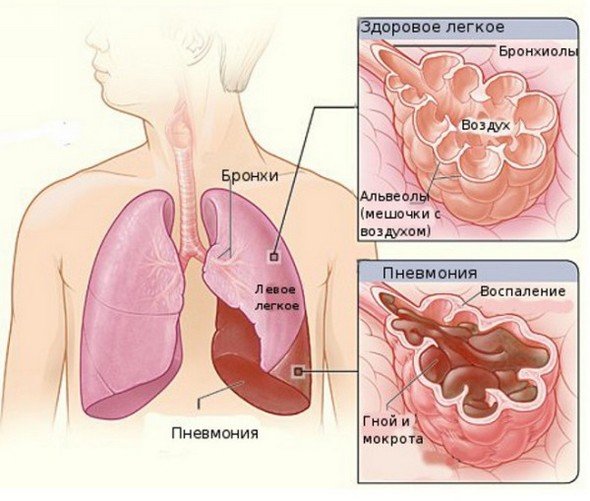 Вирусная пневмония — симптомы и лечение