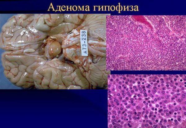 Аденома гипофиза – симптомы и лечение, фото и видео. 
