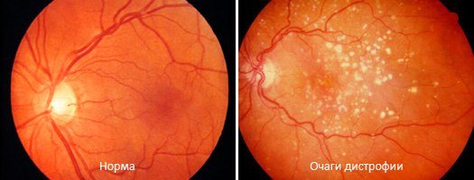 Дистрофия сетчатки глаза — симптомы и лечение, фото и видео
