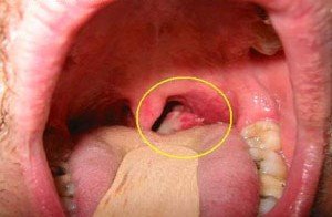 Рак корня языка — симптомы и лечение
