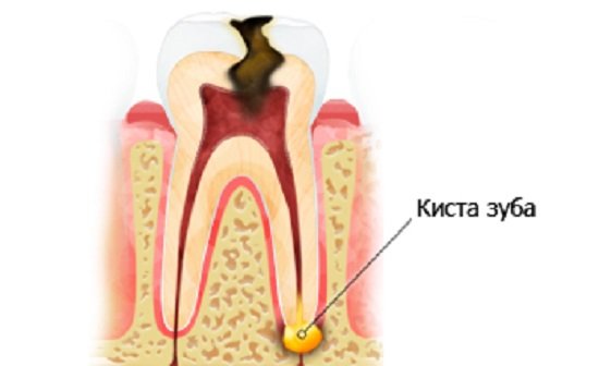 Киста зуба — симптомы и лечение