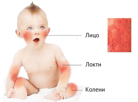 Атопический дерматит у детей — симптомы и лечение, фото и видео