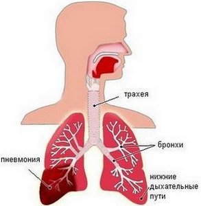 Крупозная пневмония — симптомы и лечение