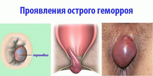 Геморрой у мужчин - симптомы и лечение, фото и видео. 