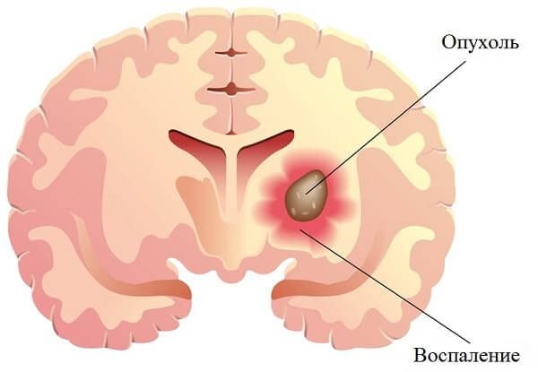 Глиома головного мозга – симптомы и лечение, фото и видео. 