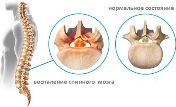 Миелит – симптомы и лечение, фото и видео. 