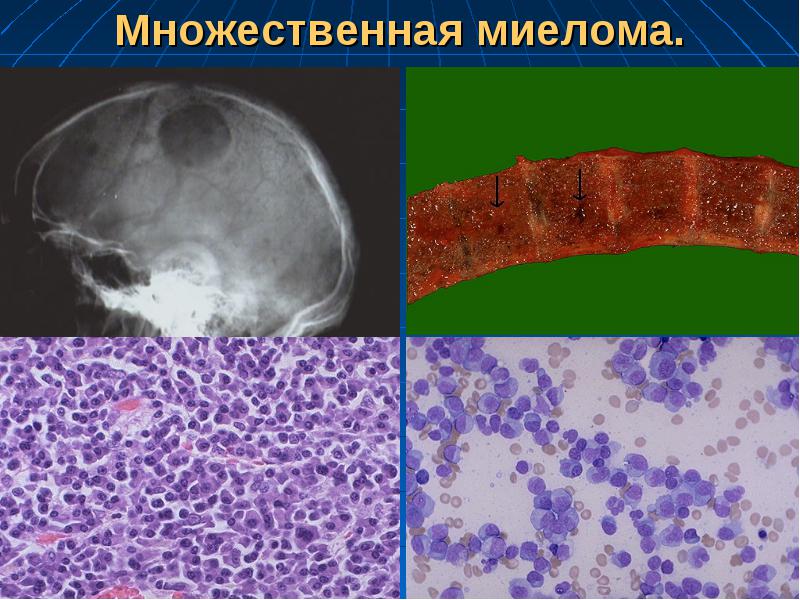 Миеломная болезнь костный мозг. Множественная миелома препарат гистология. Миеломная болезнь костный мозг гистология. Плазмоклеточная миелома. Миеломная болезнь кости.