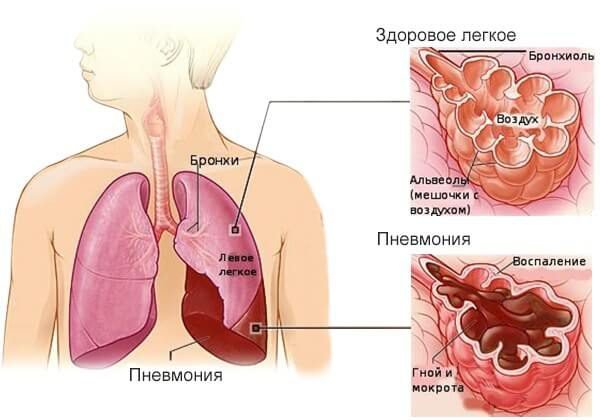 Пневмония – симптомы и лечение, фото и видео. 