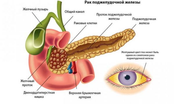 Пример поражения опухолью поджелудочной железы. 