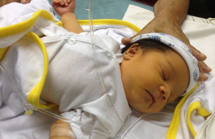 Симптомы и лечение ядерной желтухи новорожденных