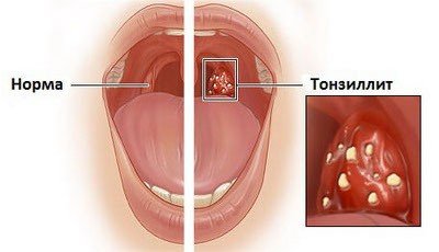 Тонзиллит у детей - симптомы и лечение, фото и видео. 