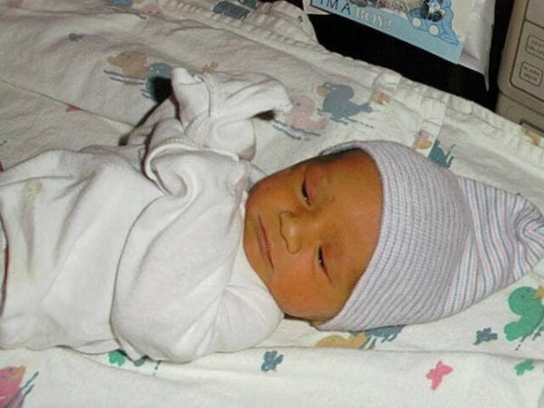 Холестаз новорожденного – симптомы и лечение, фото и видео. 