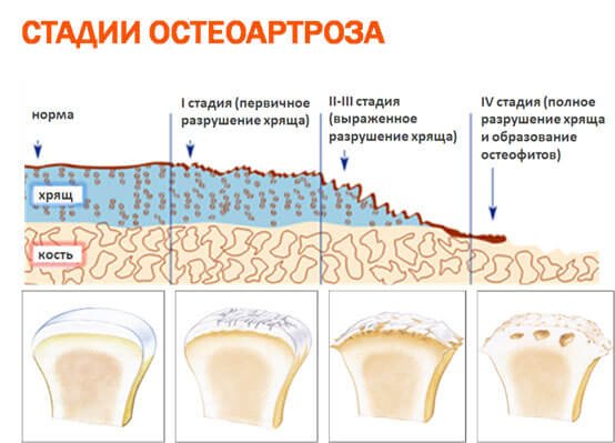 Деформирующий остеоартроз – симптомы и лечение, фото и видео. 