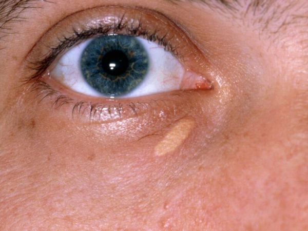 Ксантома на коже – симптомы и лечение, фото и видео. 