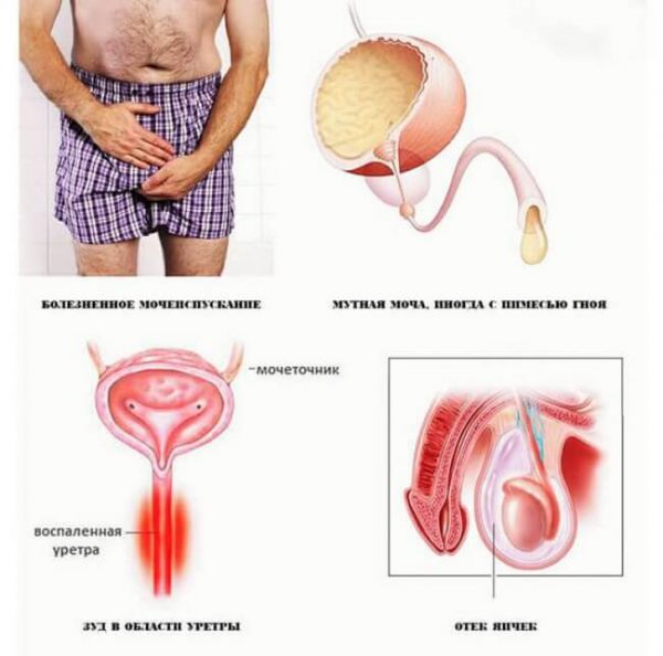 Хламидиоз у мужчин - симптомы и лечение, фото и видео. 
