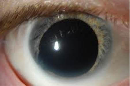 Афакия глаз – симптомы и лечение, фото и видео. 