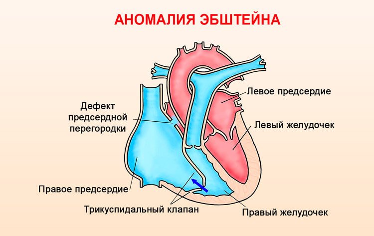 Аномалия эбштейна фото