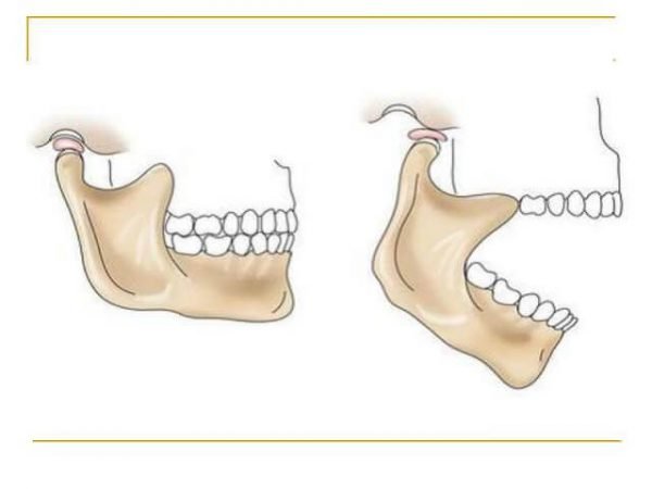 Вывих нижней челюсти – симптомы и лечение, фото и видео. 