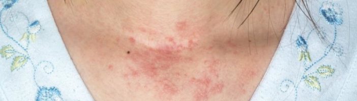 Болезнь Шамберга — симптомы и лечение, фото и видео