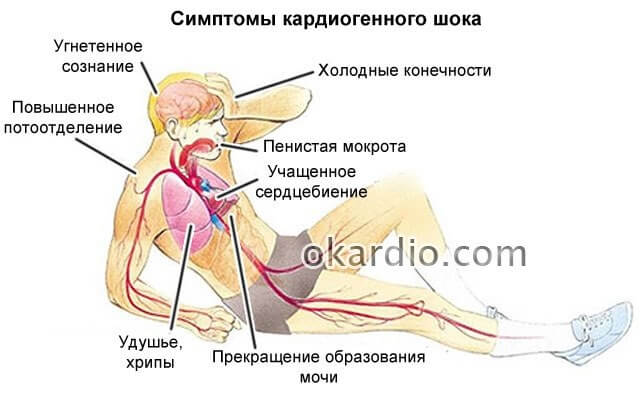 Клиническая картина кардиогенного шока