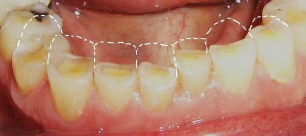Патологическая стираемость зубов – симптомы и лечение, фото и видео. 