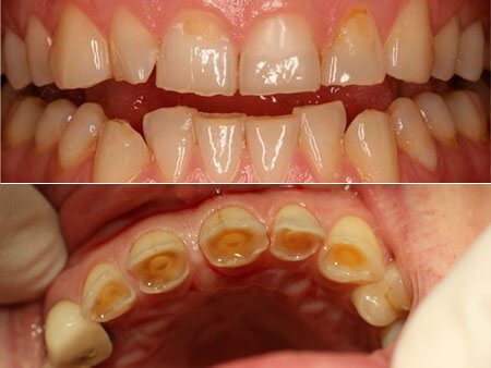 Патологическая стираемость зубов – симптомы и лечение, фото и видео. 