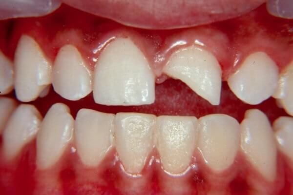 Вывих зуба – симптомы и лечение, фото и видео. 