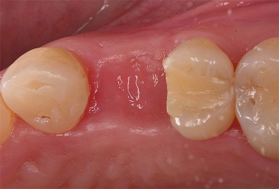 Сухая лунка после удаления зуба – симптомы и лечение, фото и видео. 