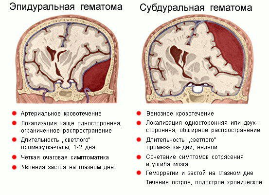 Гематома головного мозга – симптомы и лечение, фото и видео. 