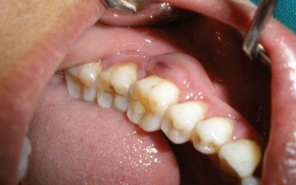Абсцесс зуба – симптомы и лечение, фото и видео. 