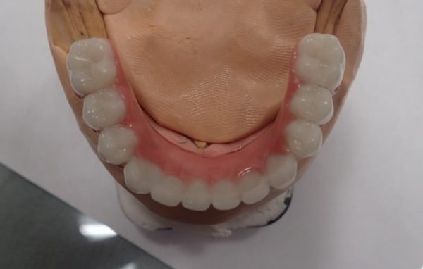 Съемные зубные протезы и правила ухода за полостью рта. 